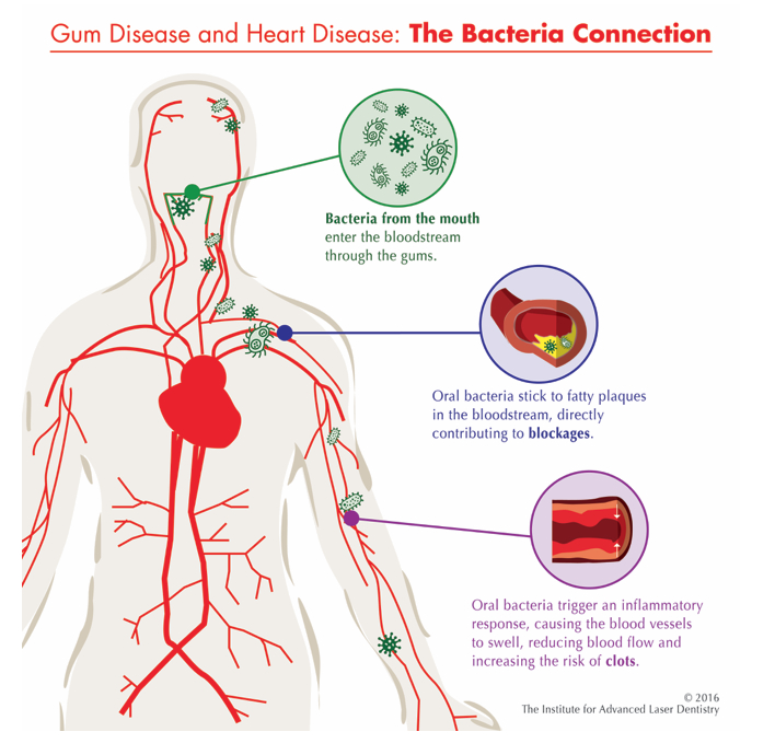 Illustrated diagram showing the link between gum disease and heart disease, highlighting how oral bacteria enter the bloodstream through inflamed gums, contribute to plaque build up in blood vessels, trigger inflammation, reduce blood flow, and increase the risk of clots and heart problems.