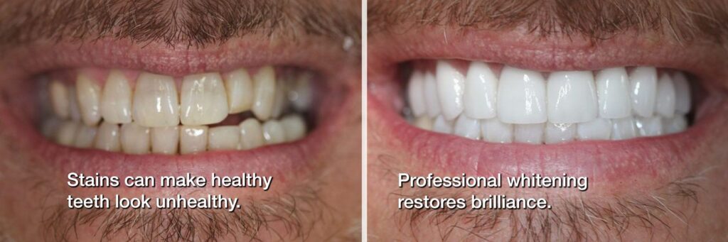 Side-by-side comparison of a man’s smile before and after professional teeth whitening, showing stained, discoloured teeth on the left and a brighter, whiter smile on the right to illustrate the cosmetic improvement.