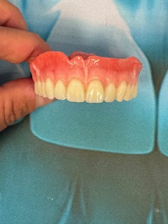 Front view of a custom Swiss denture with natural-looking prosthetic teeth, designed for improved comfort, stability and smile aesthetics.
