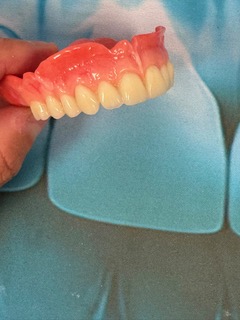 Angled side view of a custom Swiss denture showing natural tooth positioning, precise fit and realistic smile aesthetics.