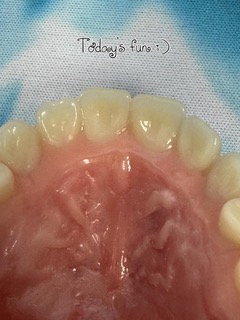 Palatal view of a custom Swiss denture showing the precise fit, full palate coverage and natural tooth arrangement.