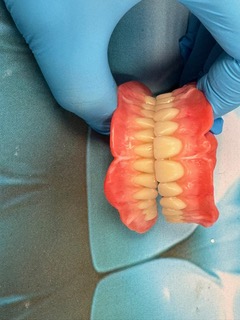 Upper and lower Swiss dentures in occlusion demonstrating a stable bite, natural tooth alignment and improved chewing function.