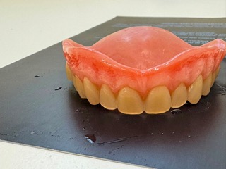 Upper Swiss denture with natural-looking prosthetic teeth, designed to provide improved stability, comfort and chewing efficiency.