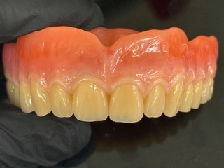 Upper Swiss denture with natural-looking prosthetic teeth, designed to improve stability, comfort and chewing function.