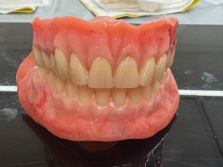 Completed Swiss dentures showing upper and lower full dentures with natural-looking teeth, designed for improved stability, chewing comfort and smile aesthetics.
