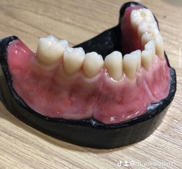 Lower Swiss denture (Gerber denture) showing the precision fit and natural tooth arrangement for improved stability and chewing comfort.