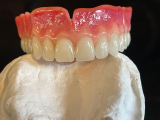 Swiss denture showing final tooth arrangement and gum contour.