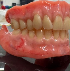 Side profile of completed Swiss dentures showing balanced occlusion, natural tooth alignment and improved denture stability.